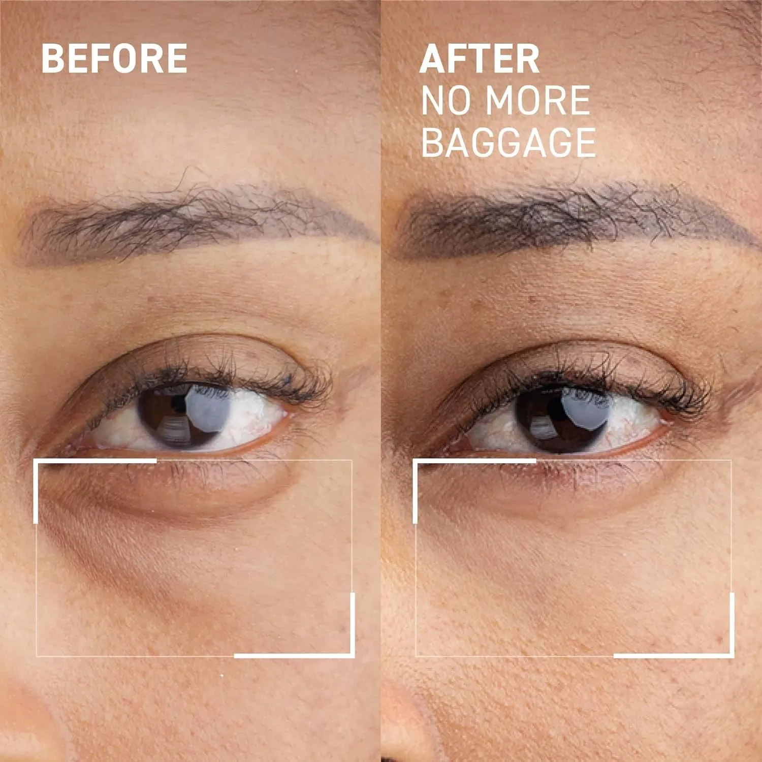 Needles No More Baggage Eye Gel Unisex, Nude, 0.5 Oz