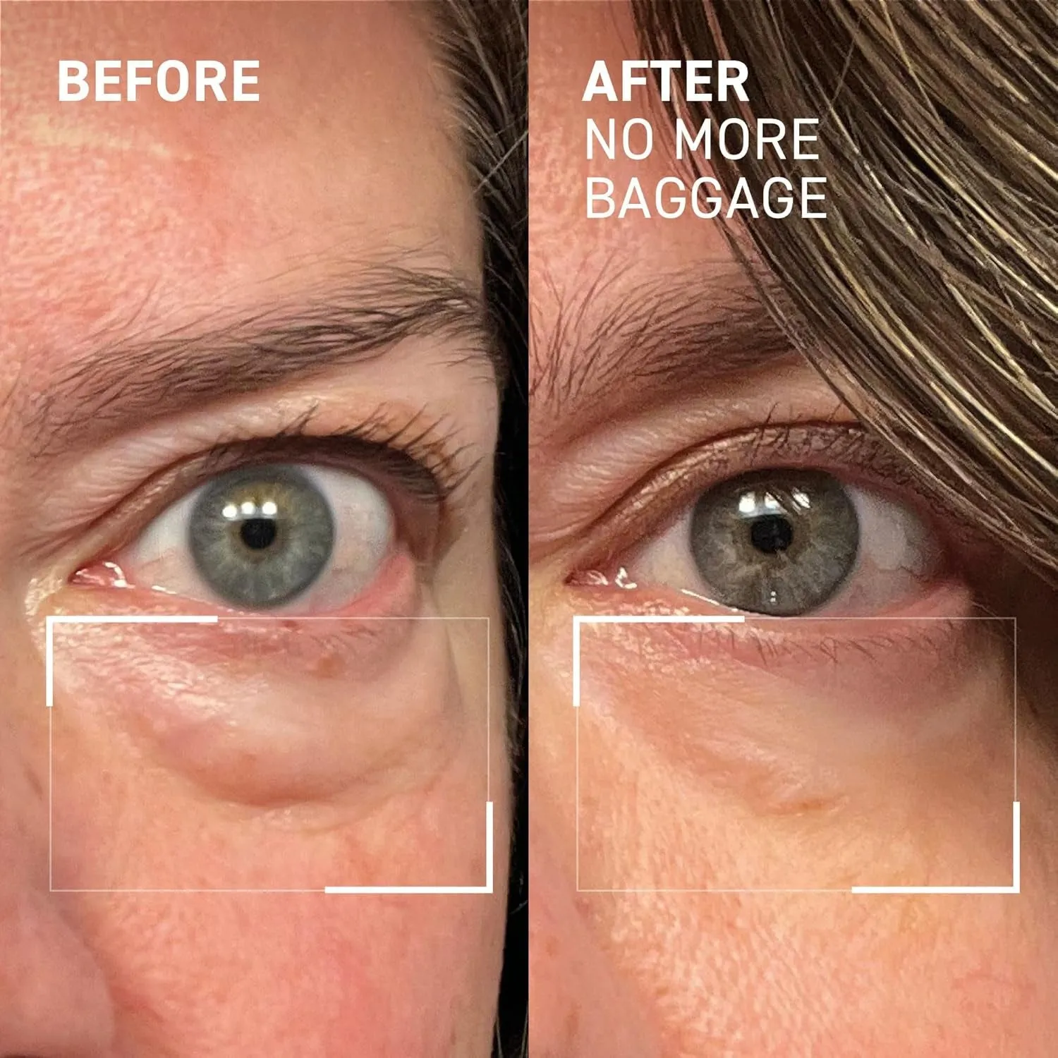 Needles No More Baggage Eye Gel Unisex, Nude, 0.5 Oz